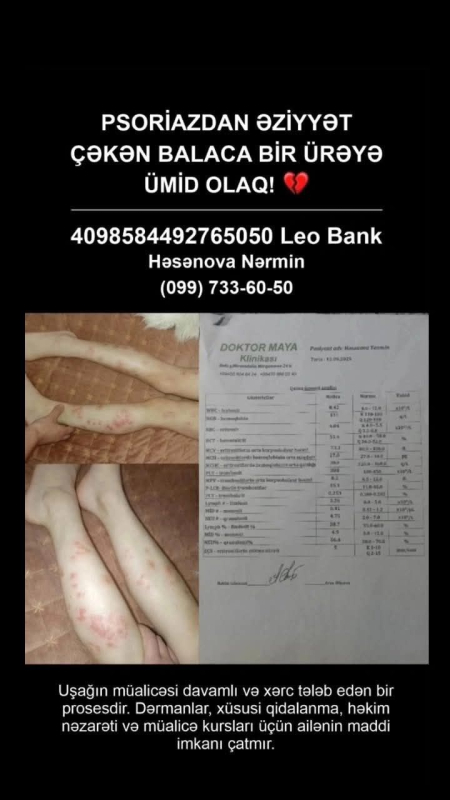 3 ildir psoriaz xəstəliyindən əziyyət çəkən azyaşlı Yasmin Həsənovaya dəstək olaq